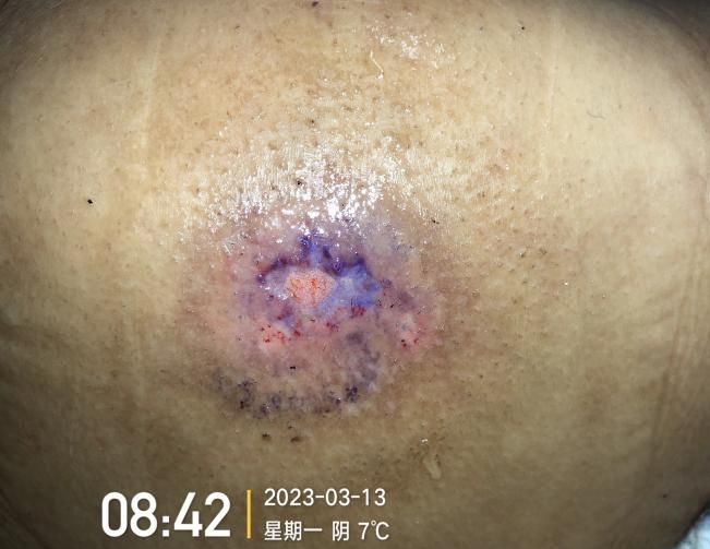 九游娱乐文化:敷贴固定小妙招伤口护理好帮手!果断收藏(图8)