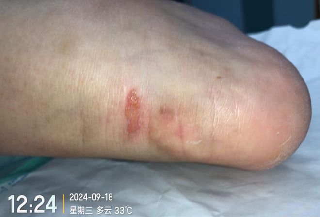 九游娱乐文化:敷贴固定小妙招伤口护理好帮手!果断收藏(图1)