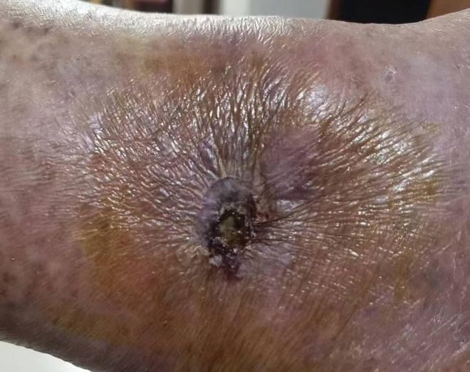 九游娱乐文化:敷贴固定小妙招伤口护理好帮手!果断收藏(图6)