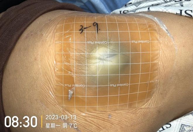 九游娱乐文化:敷贴固定小妙招伤口护理好帮手!果断收藏(图7)