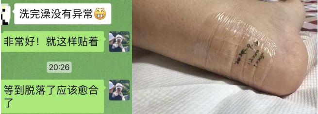 九游娱乐文化:敷贴固定小妙招伤口护理好帮手!果断收藏(图4)