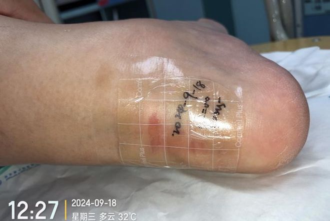 九游娱乐文化:敷贴固定小妙招伤口护理好帮手!果断收藏(图2)