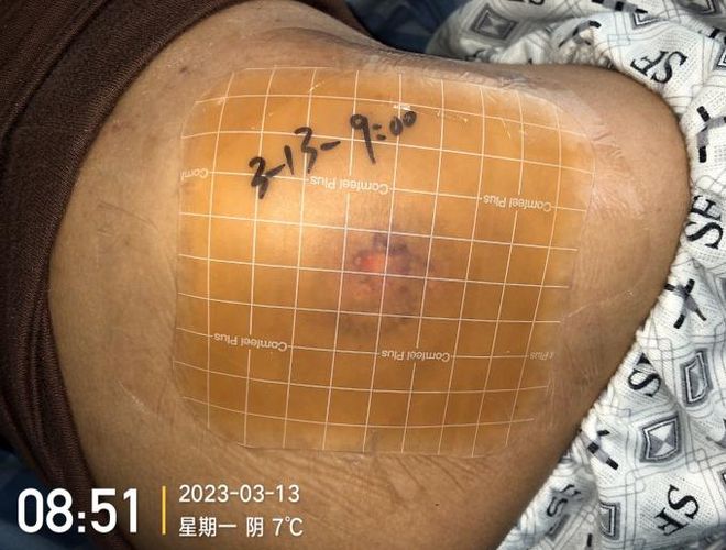 九游娱乐文化:敷贴固定小妙招伤口护理好帮手!果断收藏(图10)